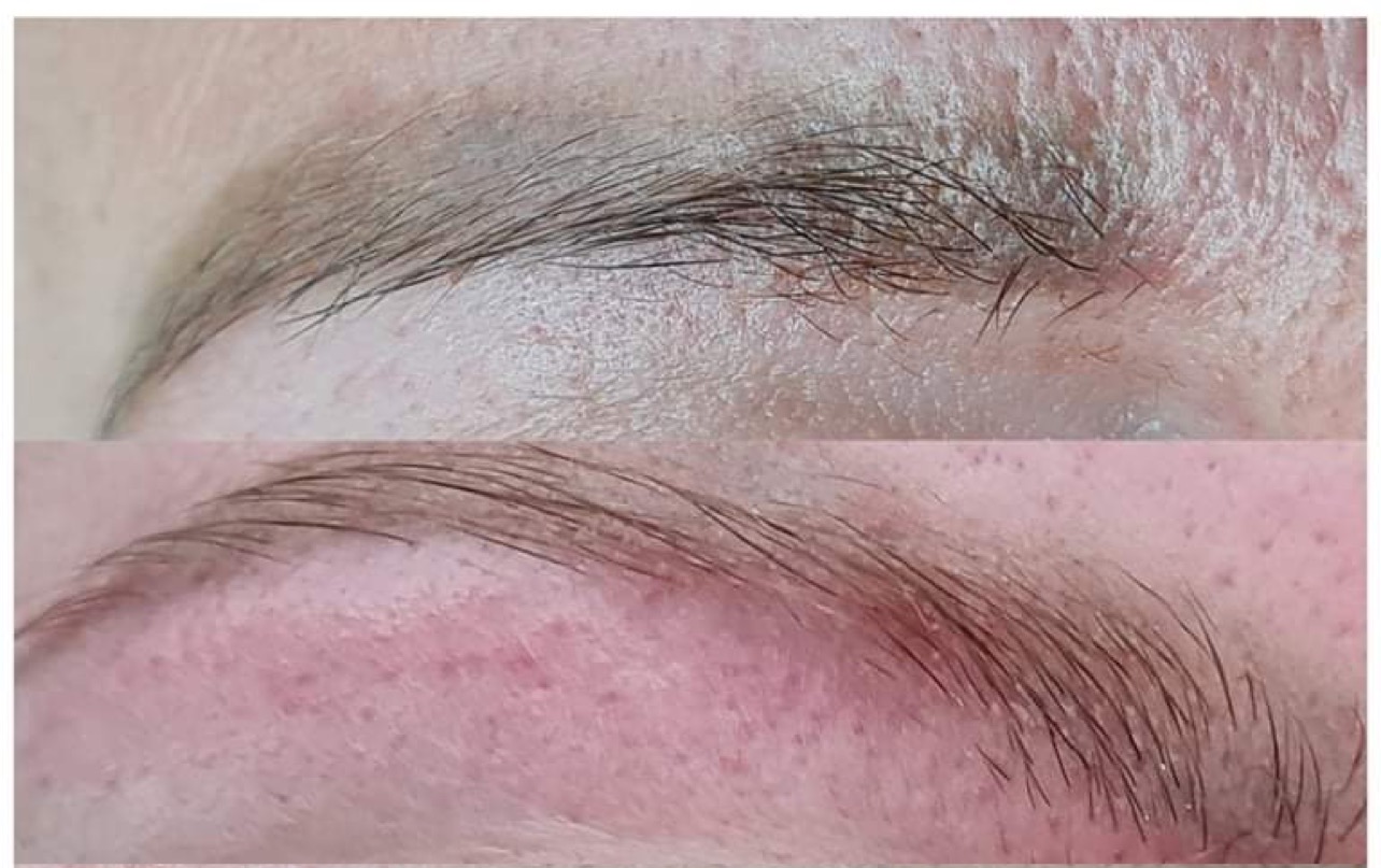PMU Removal Augenbrauen